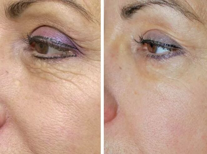 Láser de campo antes y después